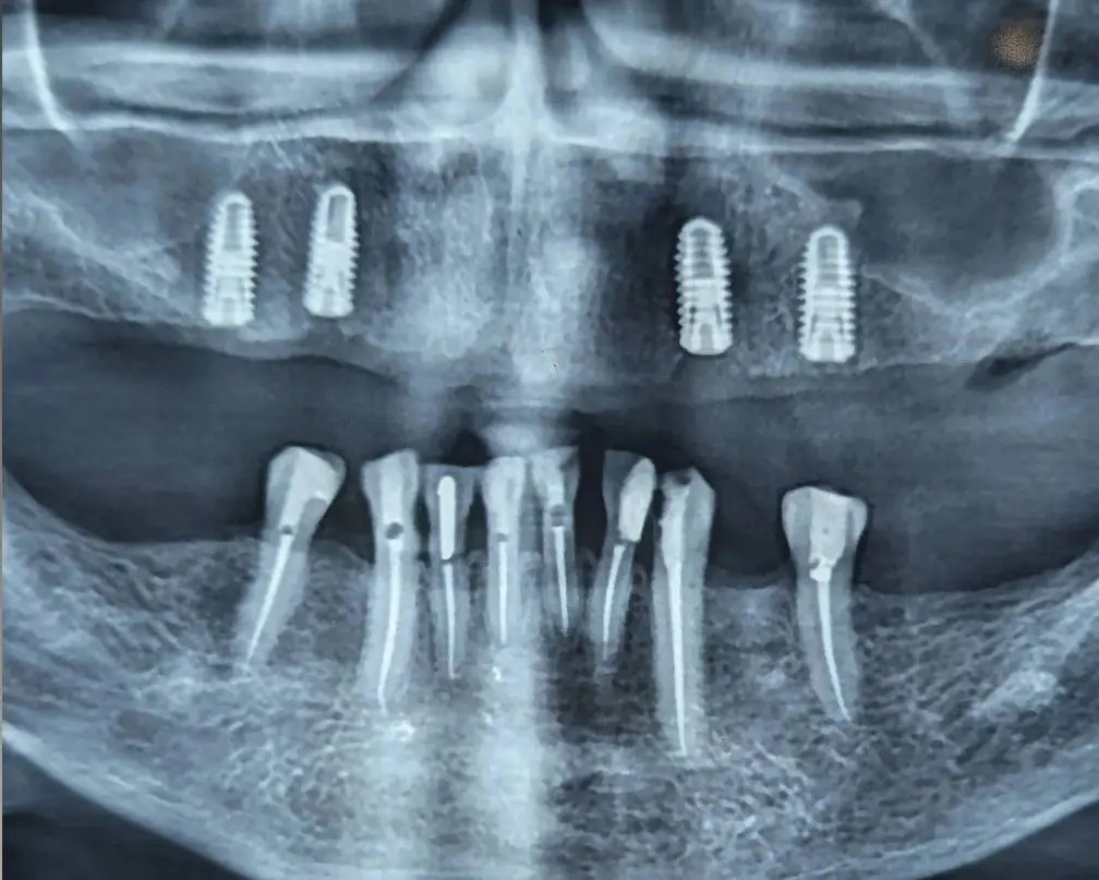 Lack of posterior occlusion; a hidden limitation for maxillary overdenture