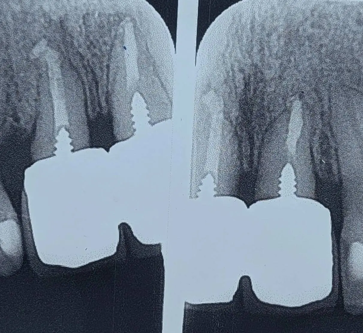 Crown lengthening on anterior teeth with short roots; bone loss and esthetic failure in the anterior zone