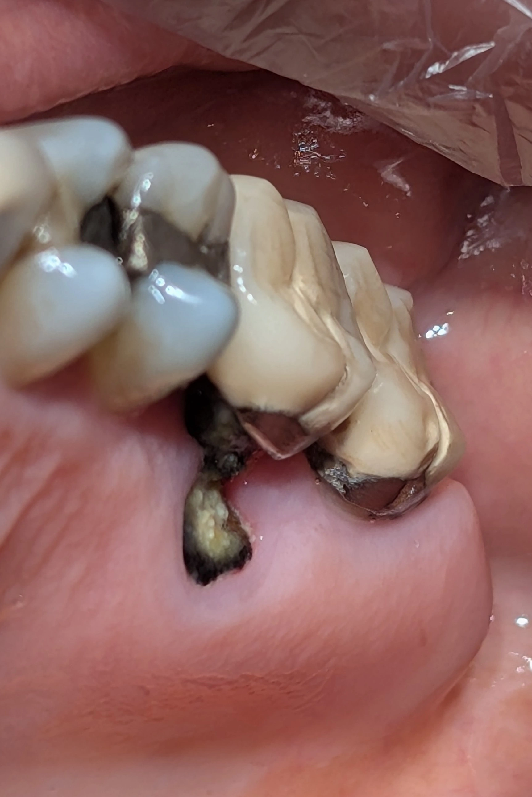 Ambiguous intraoral finding with no radiograph; differentiating a misjudged crown margin from a separate supernumerary tooth