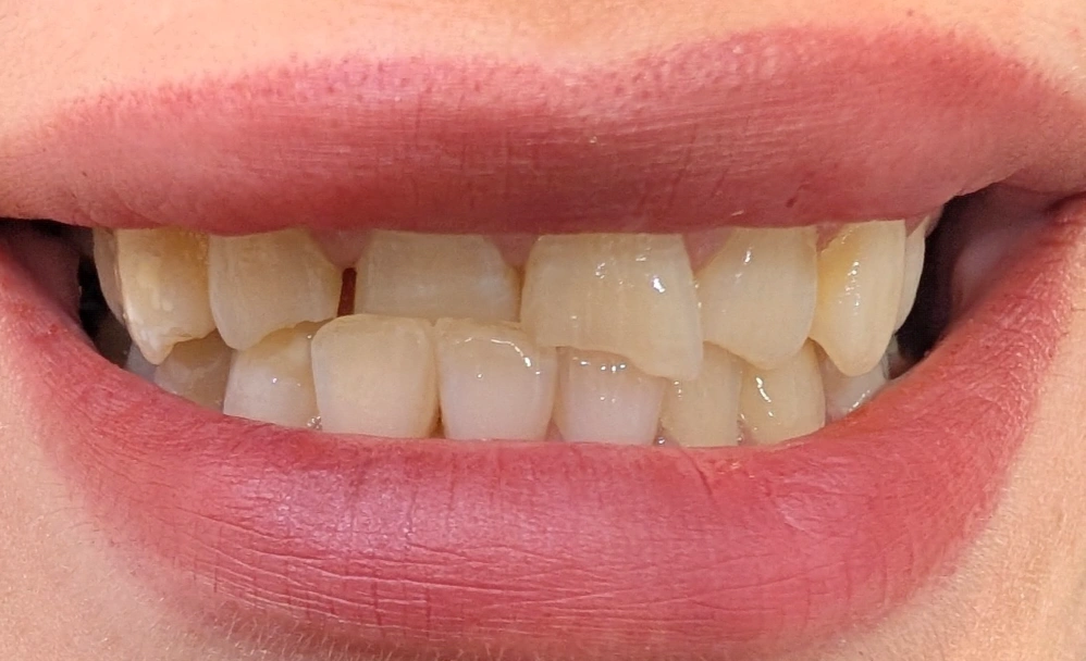 Maxillary anterior trauma case: a fractured upper left central with the opposing lower incisor supererupted into the restorative space