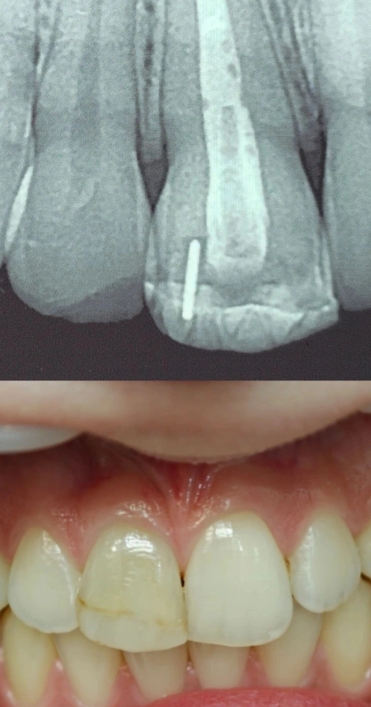 Periapical radiograph of a maxillary central incisor with gutta-percha left in the pulp chamber, next to a clinical photograph of the same tooth showing intrinsic discoloration with the natural enamel texture largely preserved.