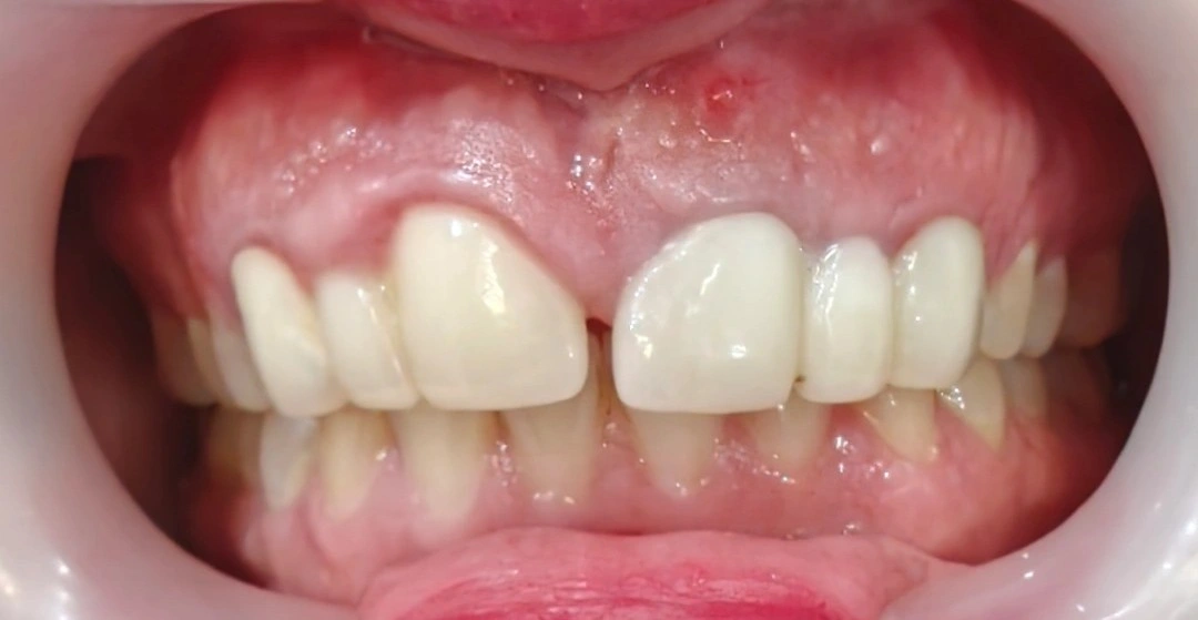 Intraoral view showing a sinus tract above the maxillary left central incisor (#21), oversized central incisors with a midline diastema, and narrow lateral incisor pontics indicating poor previous space management.