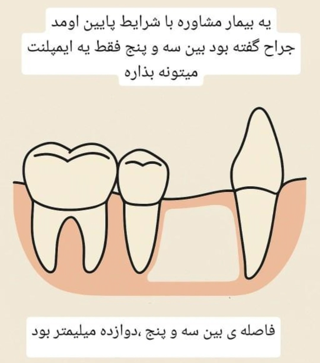 Diagram of a 12 mm edentulous span between a canine and a second premolar, with a note that the surgeon said only one implant can be placed.