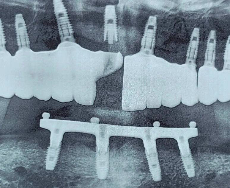 Radiograph of both jaws: a maxillary implant-supported ceramic bridge with a fractured ceramic segment where a crown has separated, opposed by an implant-supported bar in the mandible.