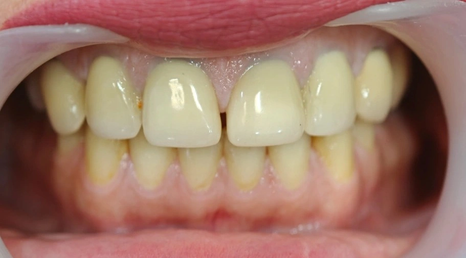Intraoral view with cheek retractors showing crowned maxillary anterior teeth, a remaining space between the central incisors, and oversized anterior crowns.
