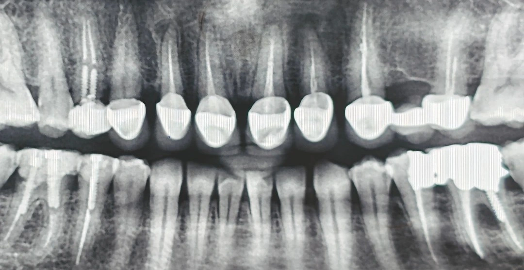 Panoramic radiograph showing the patient's crowns and the root canal treatments beneath them.