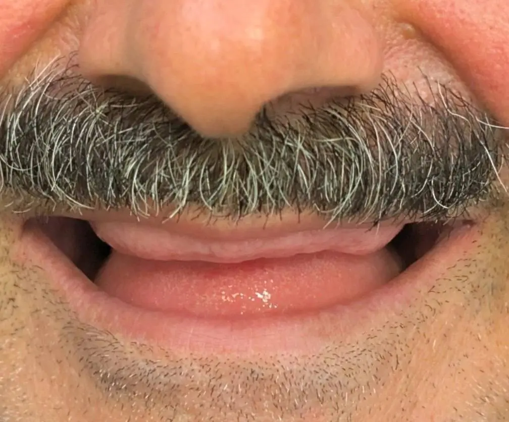 Excessive ridge display in removable prosthodontic planning case