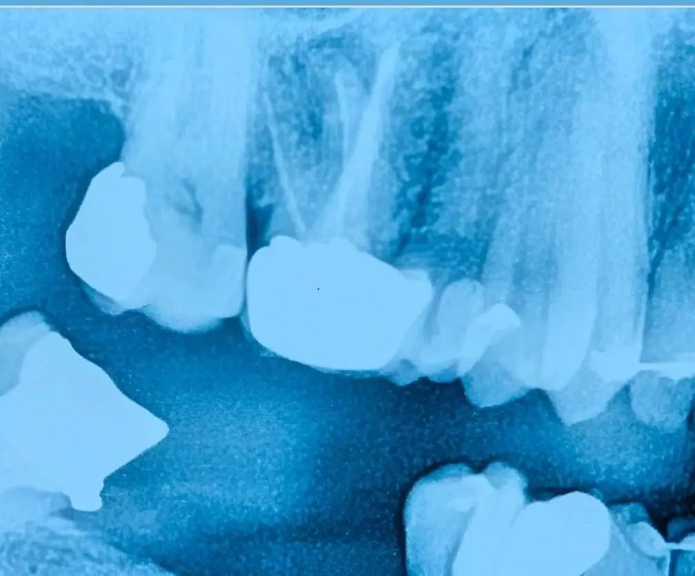 Decision making in a tooth with uncertain prognosis before definitive treatment