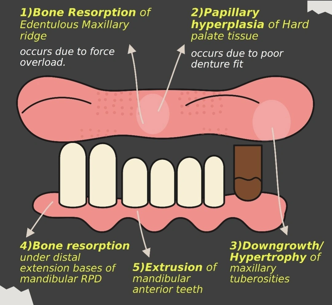 Labelled diagram of the five components attributed to combination syndrome in a patient with a maxillary complete denture opposing mandibular anterior teeth: bone resorption of the edentulous maxillary ridge, papillary hyperplasia of the hard palate, downgrowth of the maxillary tuberosities, bone resorption under the distal extension bases of the mandibular removable partial denture, and extrusion of the mandibular anterior teeth.