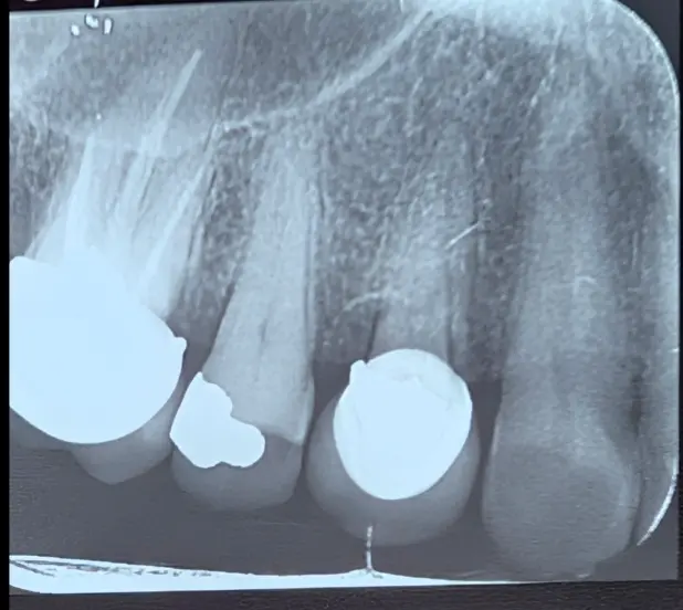 تشخیص درد دندان و مدیریت قانونی روکش تازه