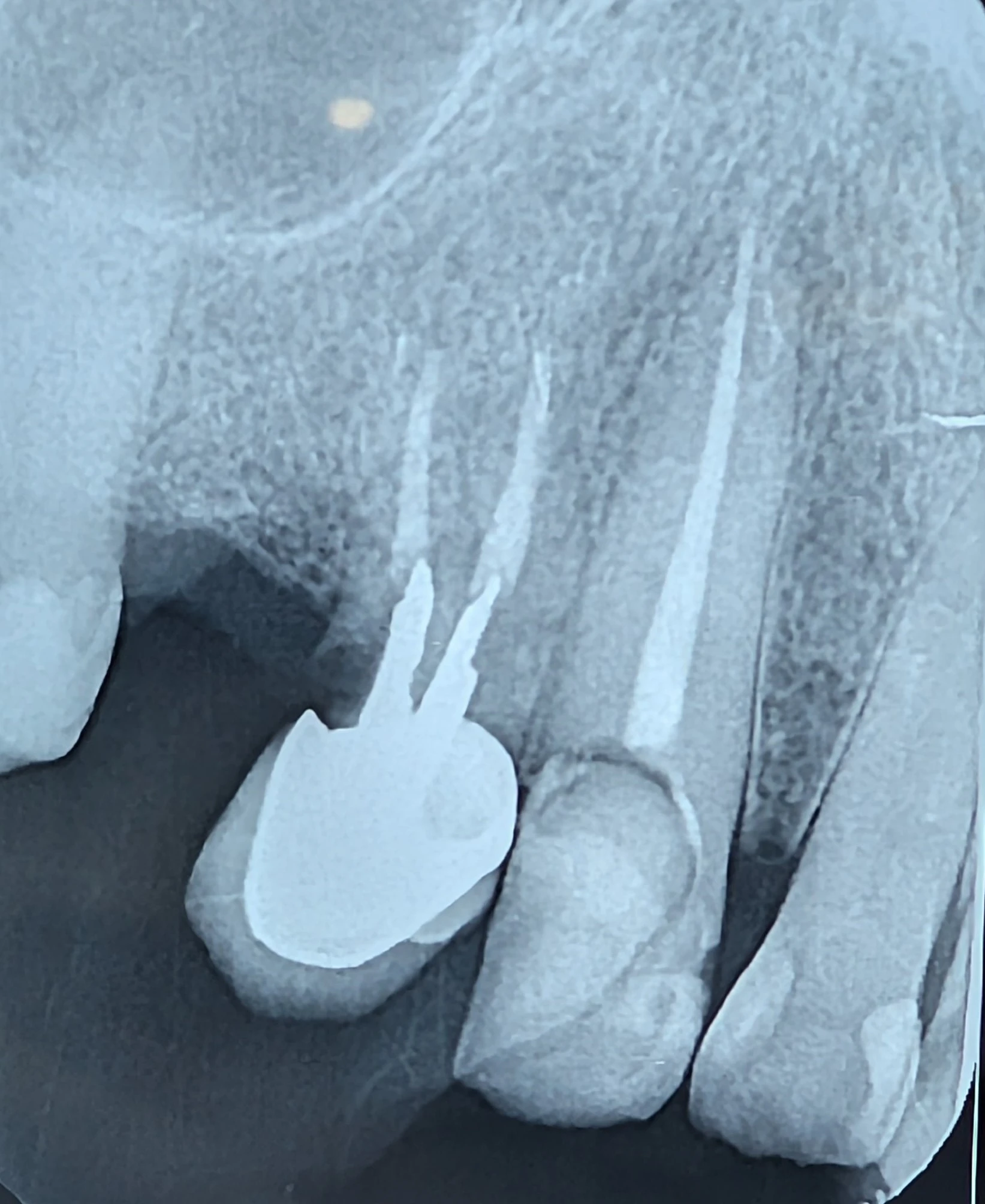 طرح درمان ایمپلنت و دندان کانین