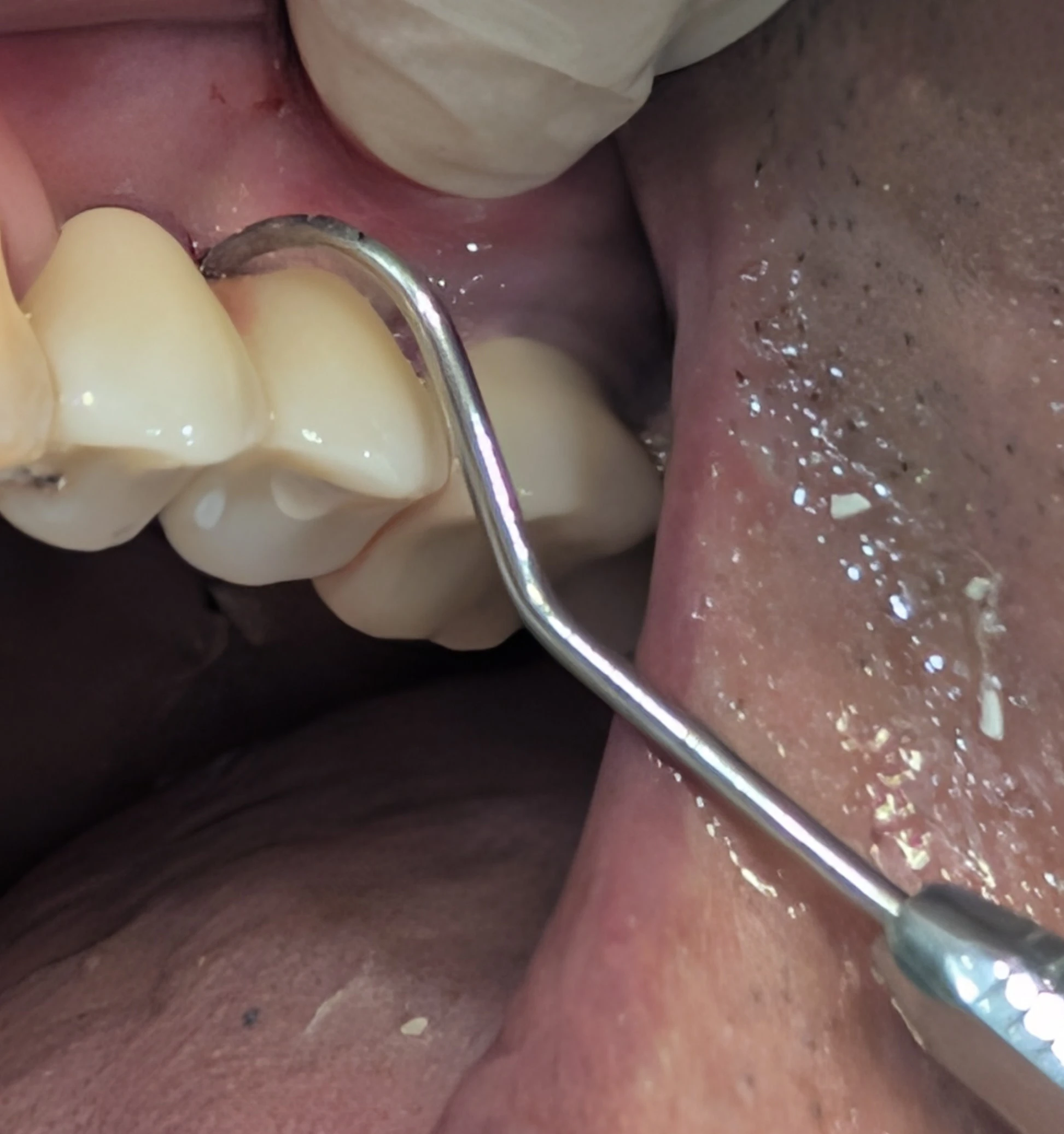 تست عبور سوند در ایمپلنت های اسپلینت شده