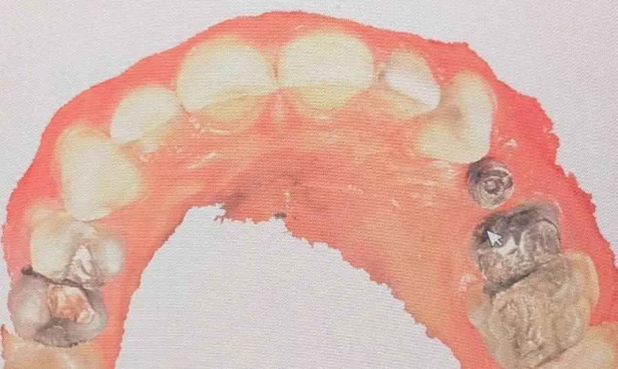 گسترش محدوده اسکن برای دستیابی به مرجع آناتومیک بهتر در طراحی تاج ایمپلنت