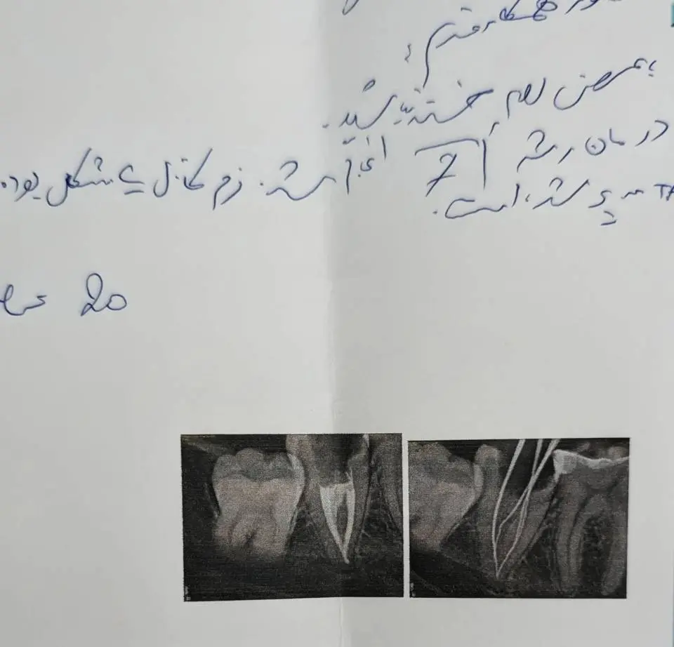 بازتعریف بازسازی پروتزی در دندانی که کانال آن دیگر نقش گیرنده پست ندارد