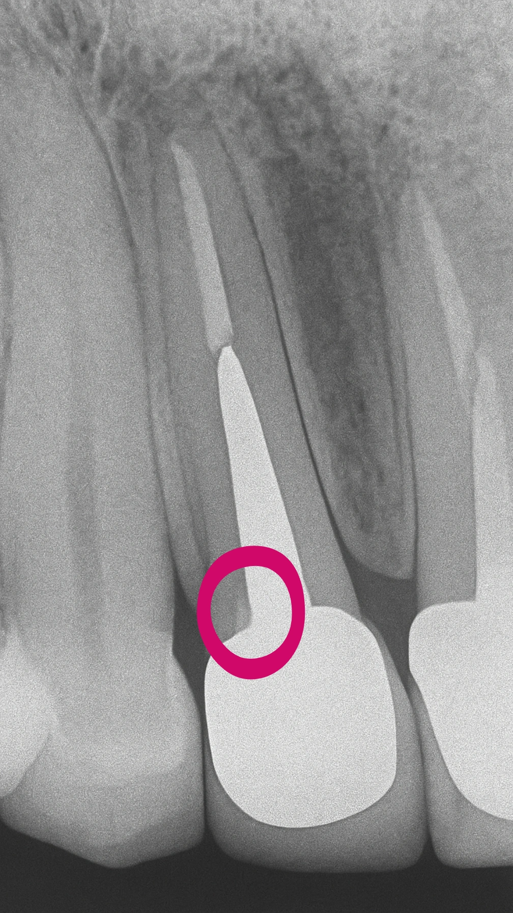 تصویری شماتیک از مفهوم بیومیمتیک و اتصال کامپوزیت به نسج دندان