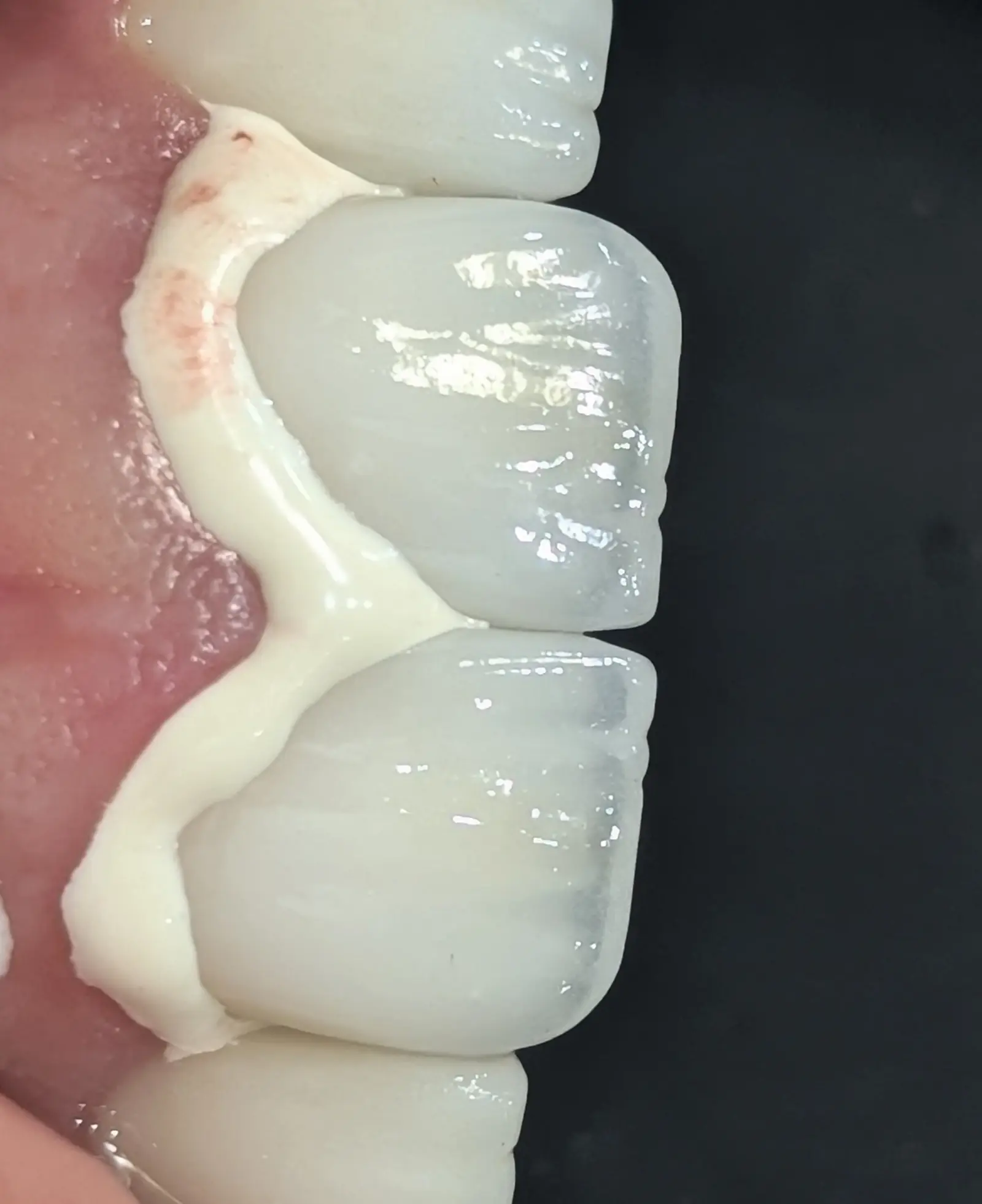 تصویری شماتیک از تفاوت رنگ در روکش‌های سرامیکی بین سمان موقت و سمان دائم