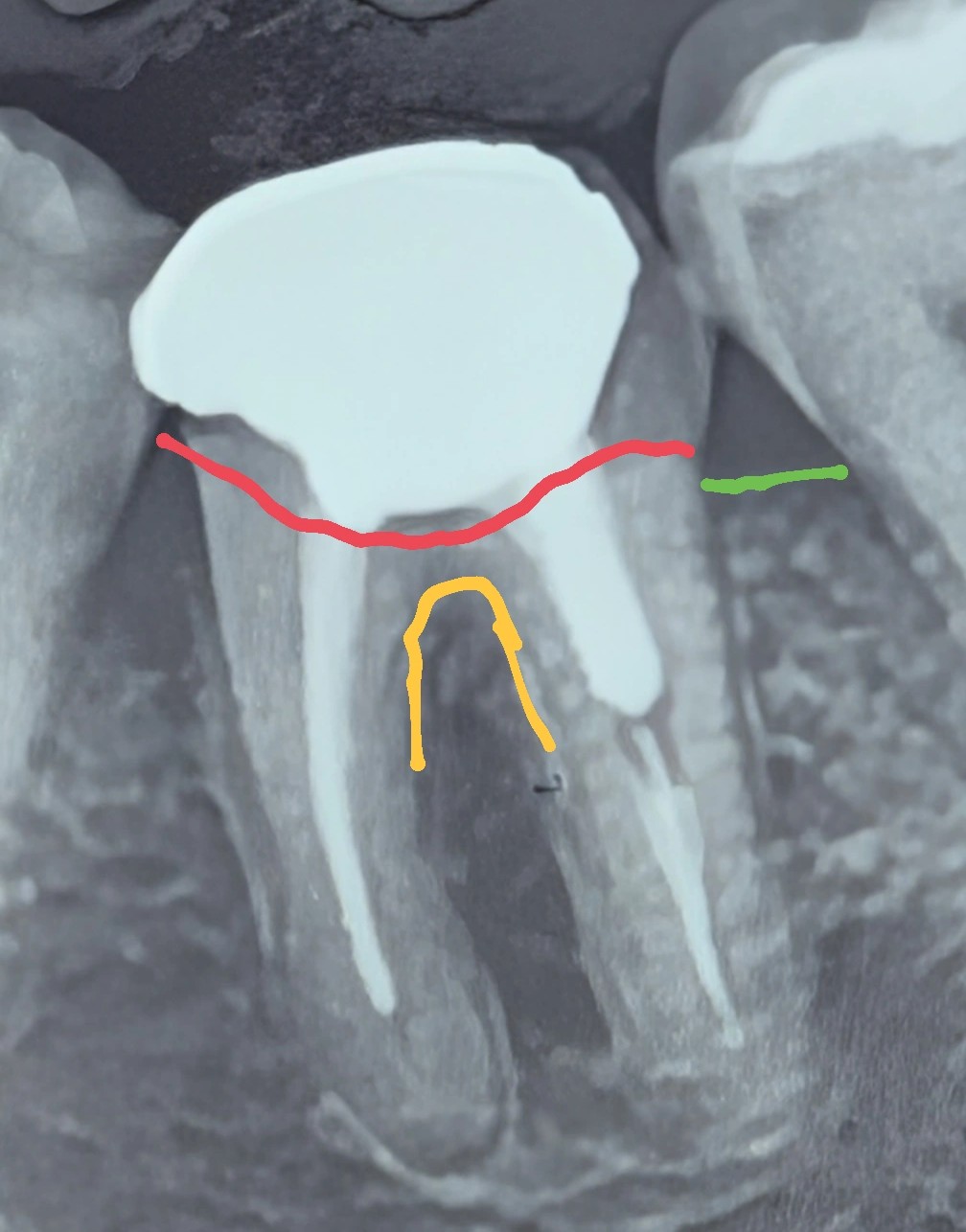 تصویری از یک دندان با تخریب گسترده ساختار و مشکلات درمان ریشه