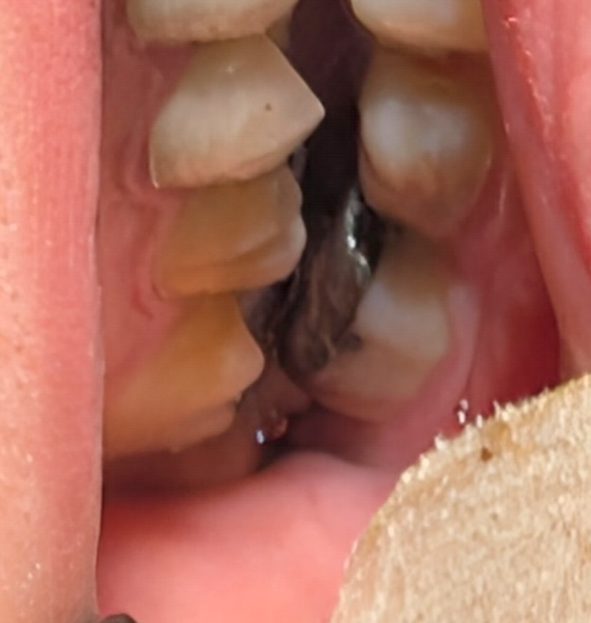 تصویری مرتبط با یک تداخل اکلوژنی در مولر سوم