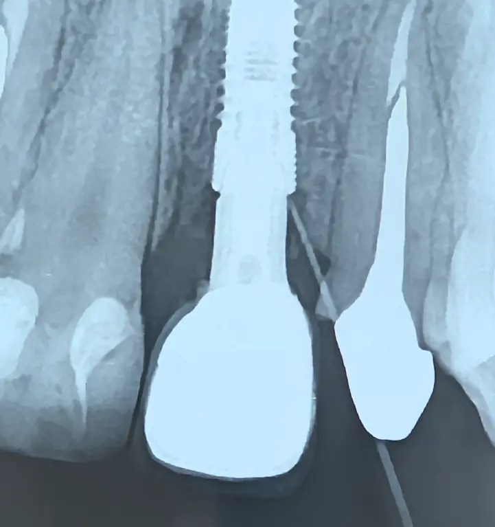 نمای تریس آبسه و ارتباط آن با کانکشن ایمپلنت
