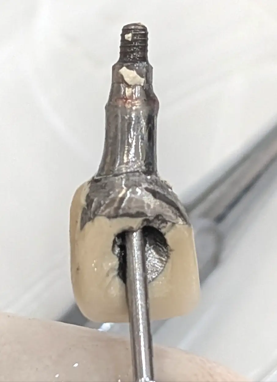 نمای داخل کانکشن ایمپلنت و سمان باقیمانده