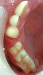 تراش ونیر و آنلهٔ دندانهای پایه برای جایگزینی پرمولر اول فک بالا.